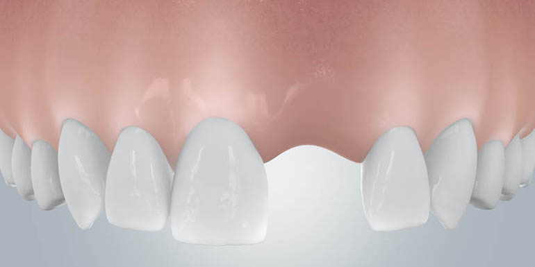 Implantate 2