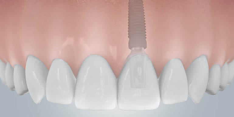 Implantate 3